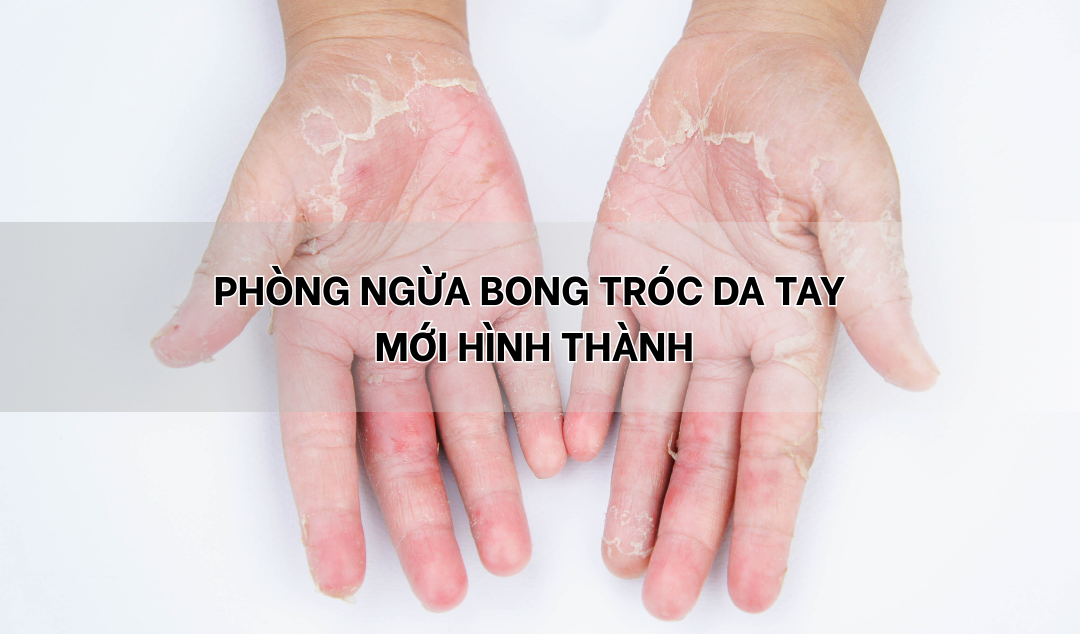Phòng ngừa bong tróc da tay mới hình thành